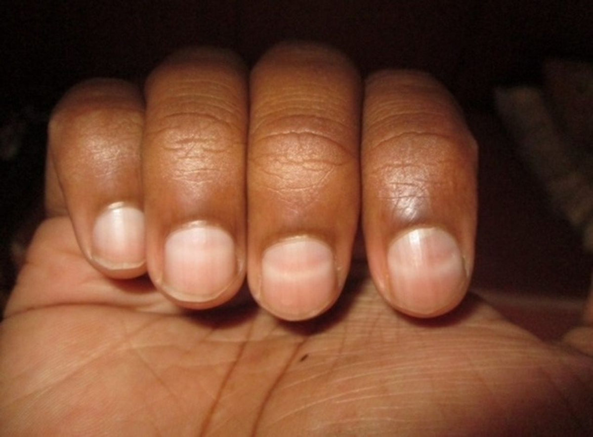What's the effect of a white spot on the surface of a nail? - Quora